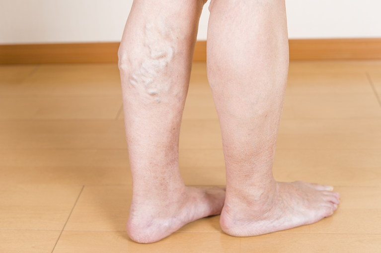 危険な足のむくみの症状